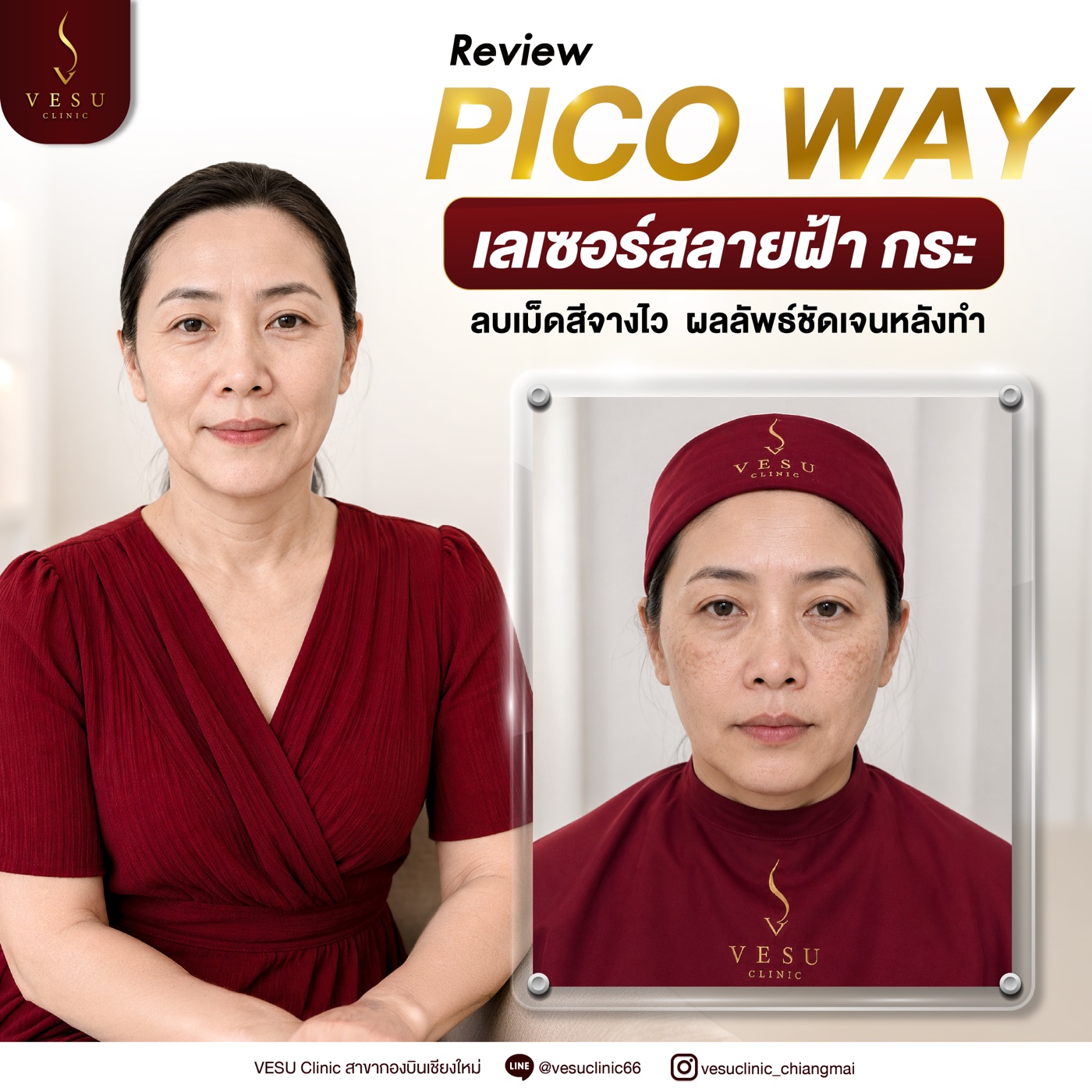 ผลลัพธ์ Pico Way เลเซอร์สลายฝ้า กระ
