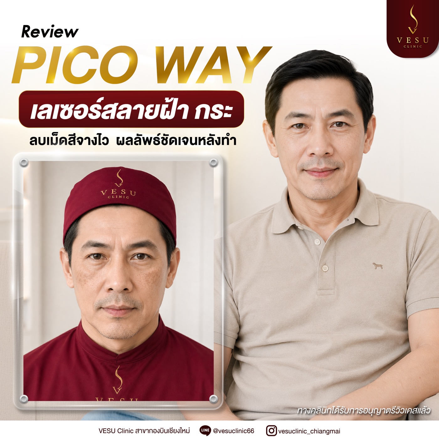 ผลลัพธ์ Pico Way ฝ้าจางลง ผิวกระจ่างใส