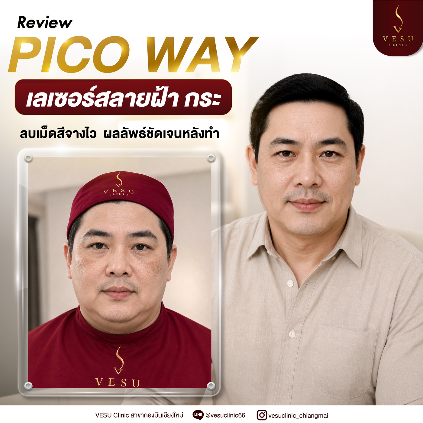 ผลลัพธ์ Pico Way ลดจุดด่างดำ