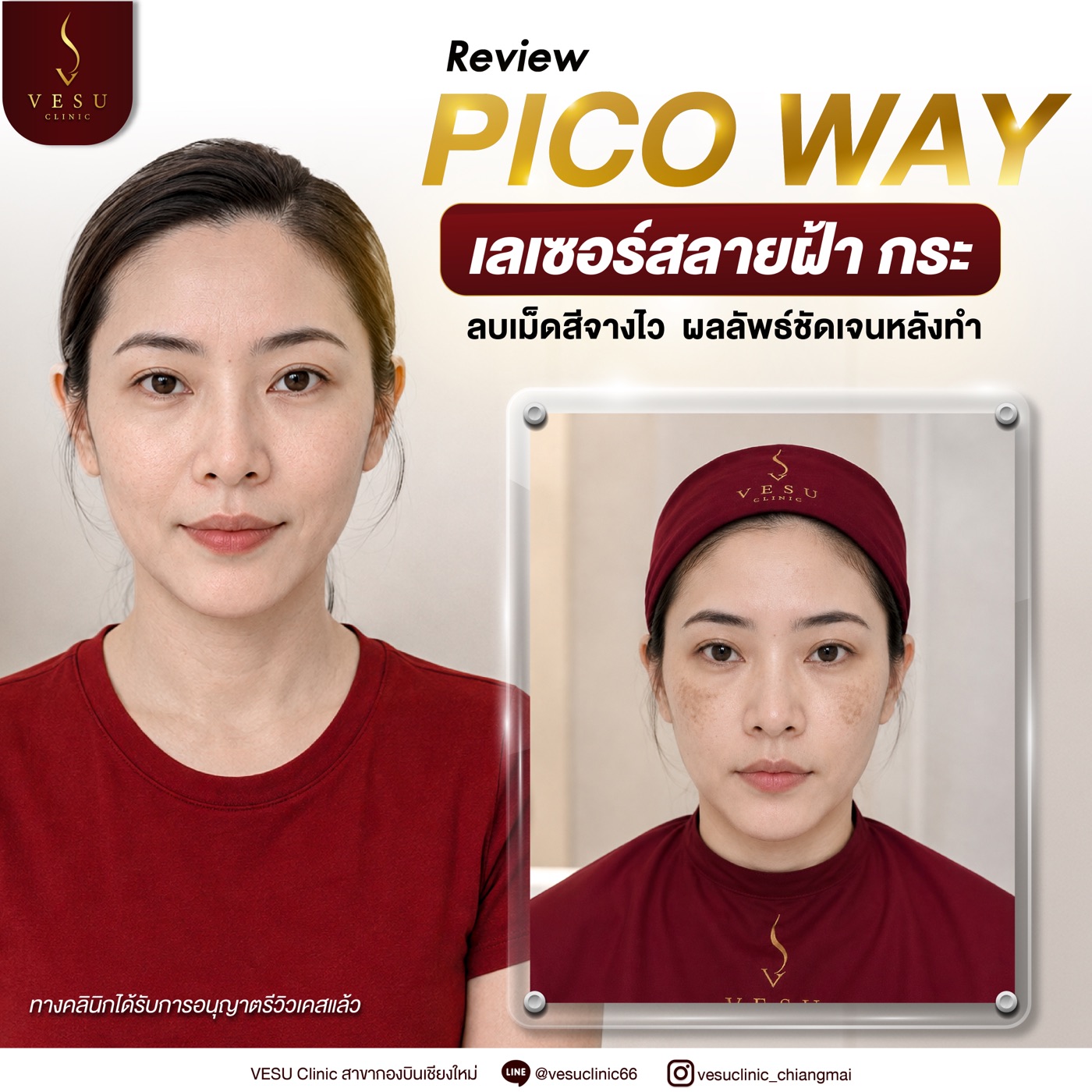 ผลลัพธ์ Pico Way ลบเม็ดสีจางไว