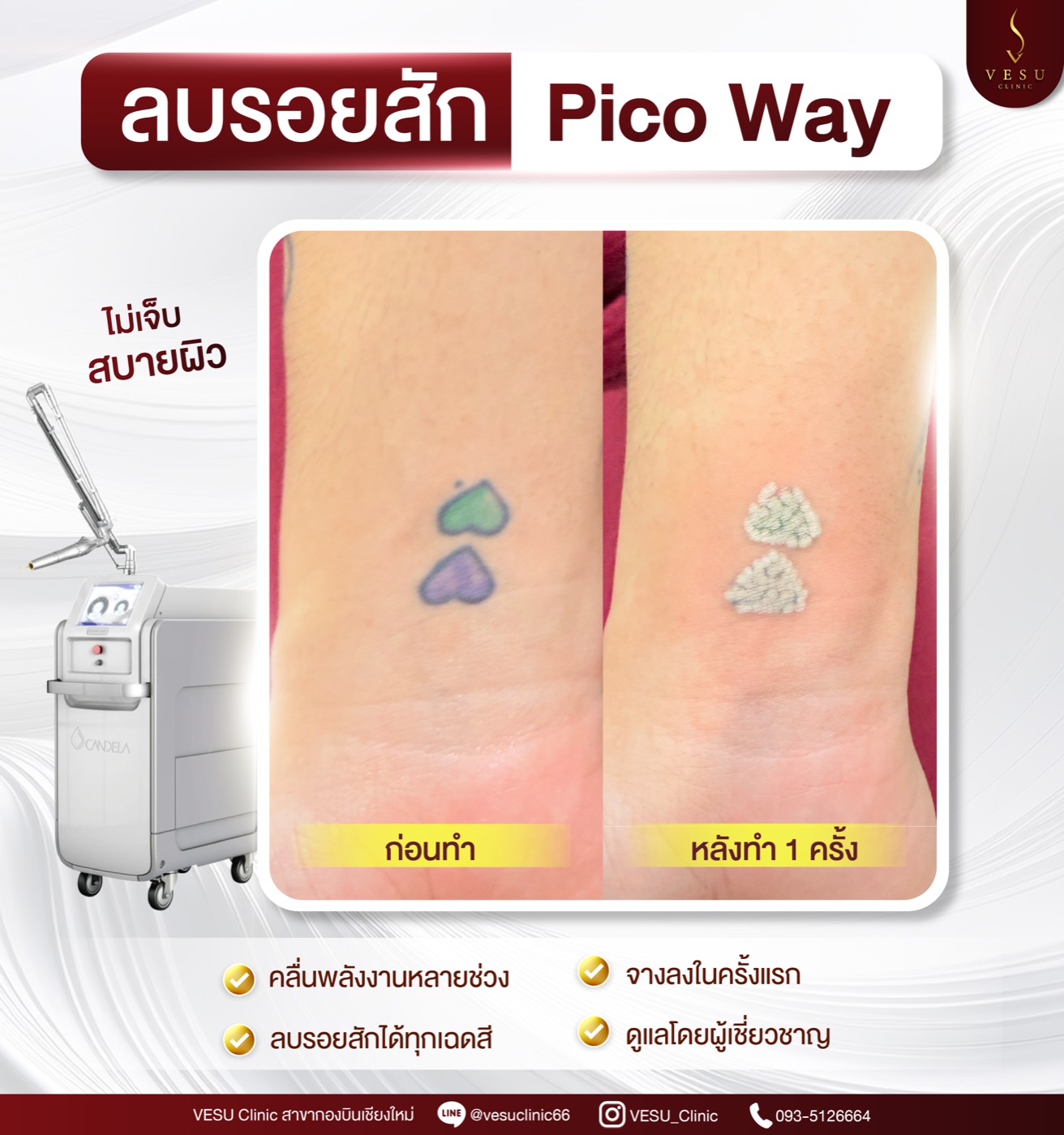 ลบรอยสักด้วย Pico Way หลังทำ 1 ครั้ง