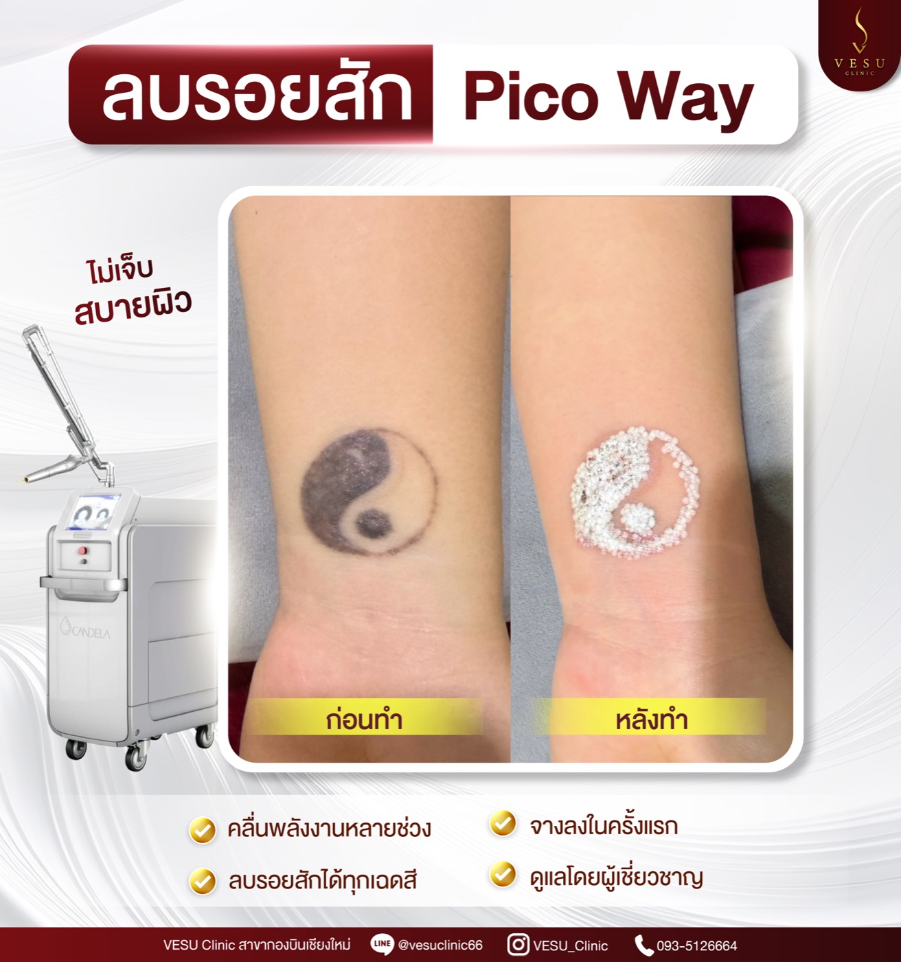 ลบรอยสักด้วย Pico Way ไม่เจ็บ สบายผิว